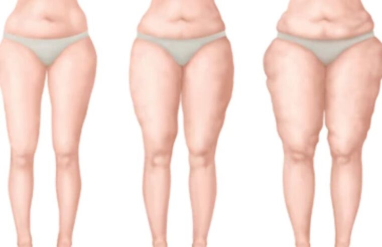 Lipedema: o que você precisa saber sobre essa doença