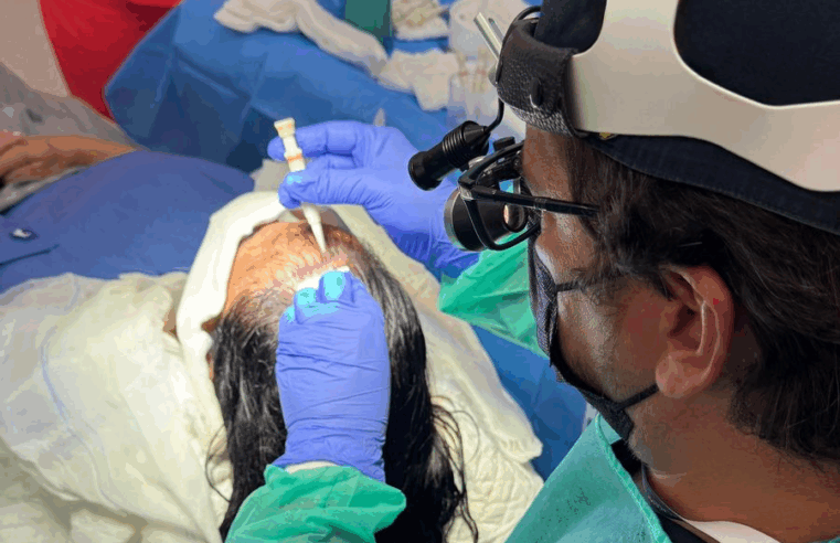 Transplante capilar com fio longo oferece alternativa médica menos invasiva e mais discreta